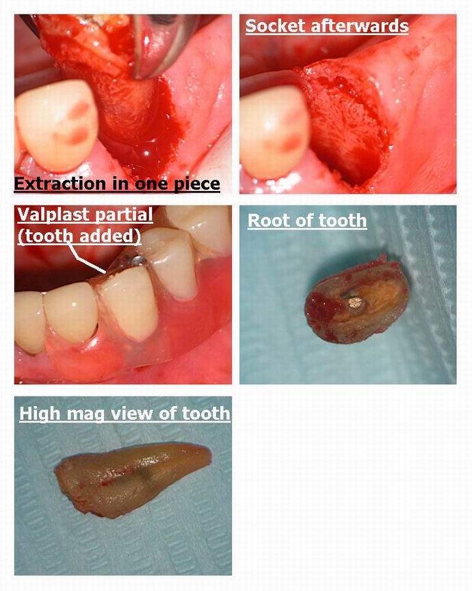 Resize of Laser assisted extraction pg 2.jpg